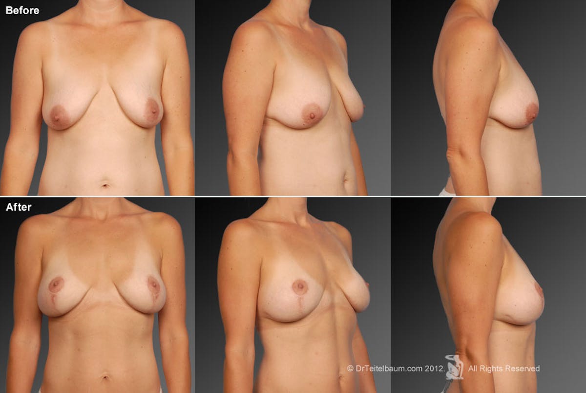 Breast Augmentation with Anchor Lift Before & After Gallery - Patient 105454228 - Image 1