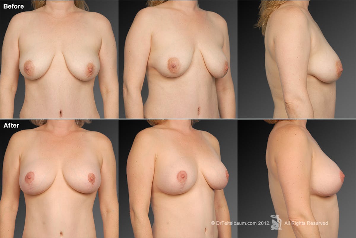 Breast Augmentation with Anchor Lift Before & After Gallery - Patient 105454230 - Image 1