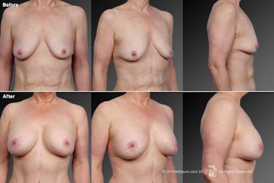 Breast Augmentation with Anchor Lift Before & After Gallery - Patient 105454233 - Image 1