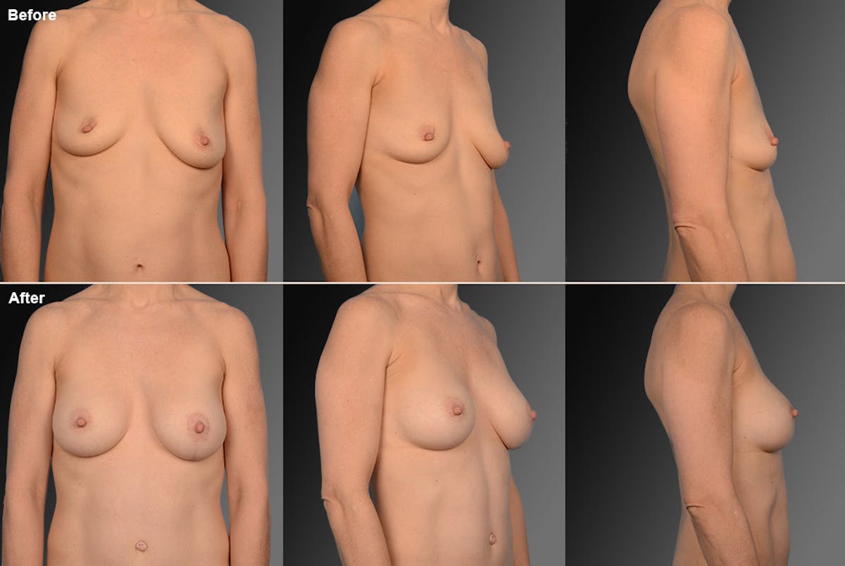 Breast Augmentation with Anchor Lift Before & After Gallery - Patient 105454237 - Image 1