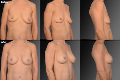Breast Augmentation with Anchor Lift Before & After Gallery - Patient 105454237 - Image 1