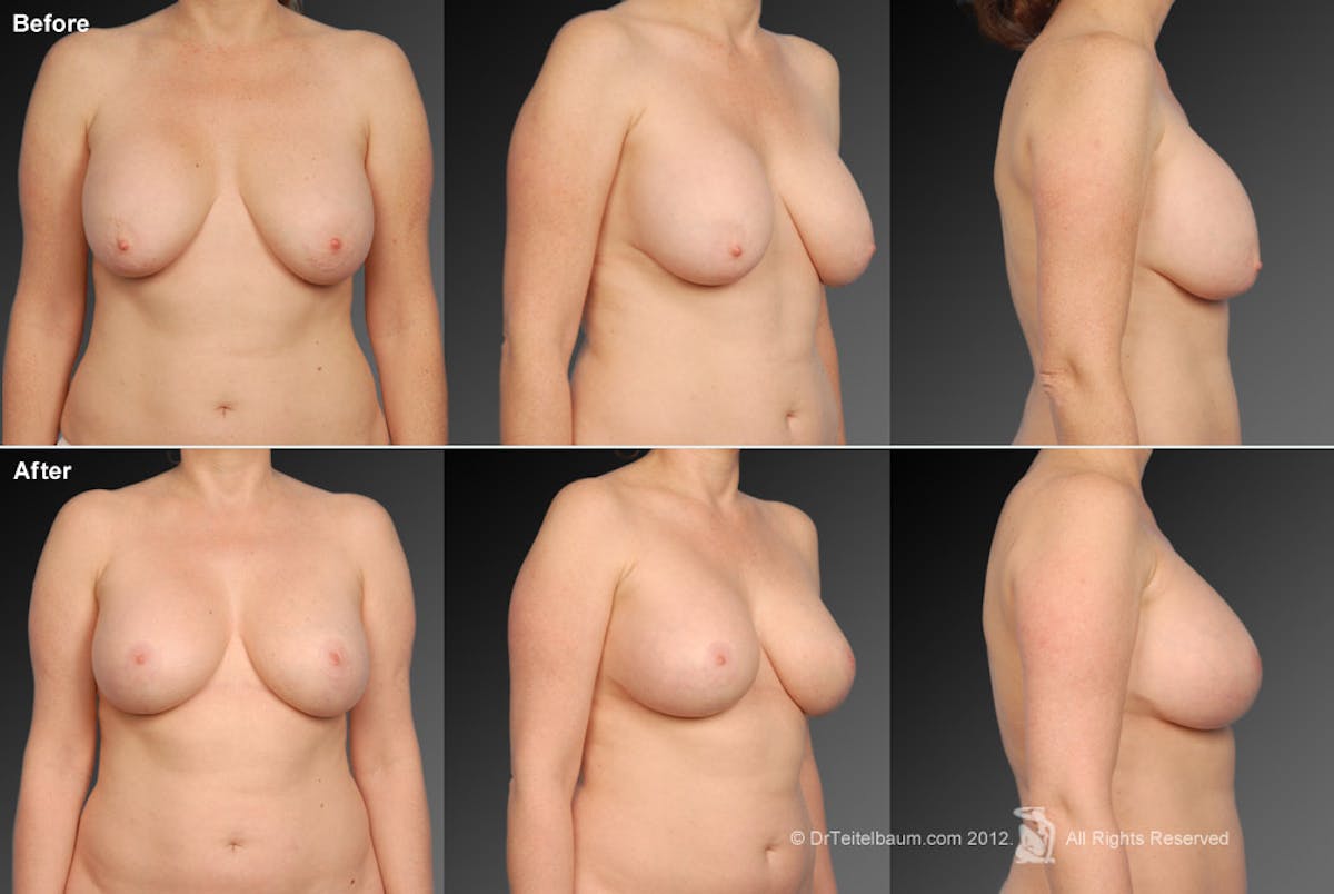 Breast Augmentation with Anchor Lift Before & After Gallery - Patient 105454241 - Image 1
