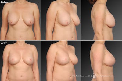 Breast Augmentation with Anchor Lift Before & After Gallery - Patient 105454241 - Image 1