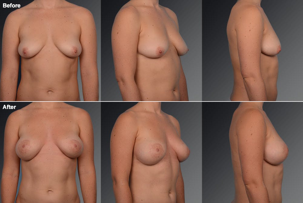 Breast Donut Lift Before & After Gallery - Patient 105454265 - Image 1