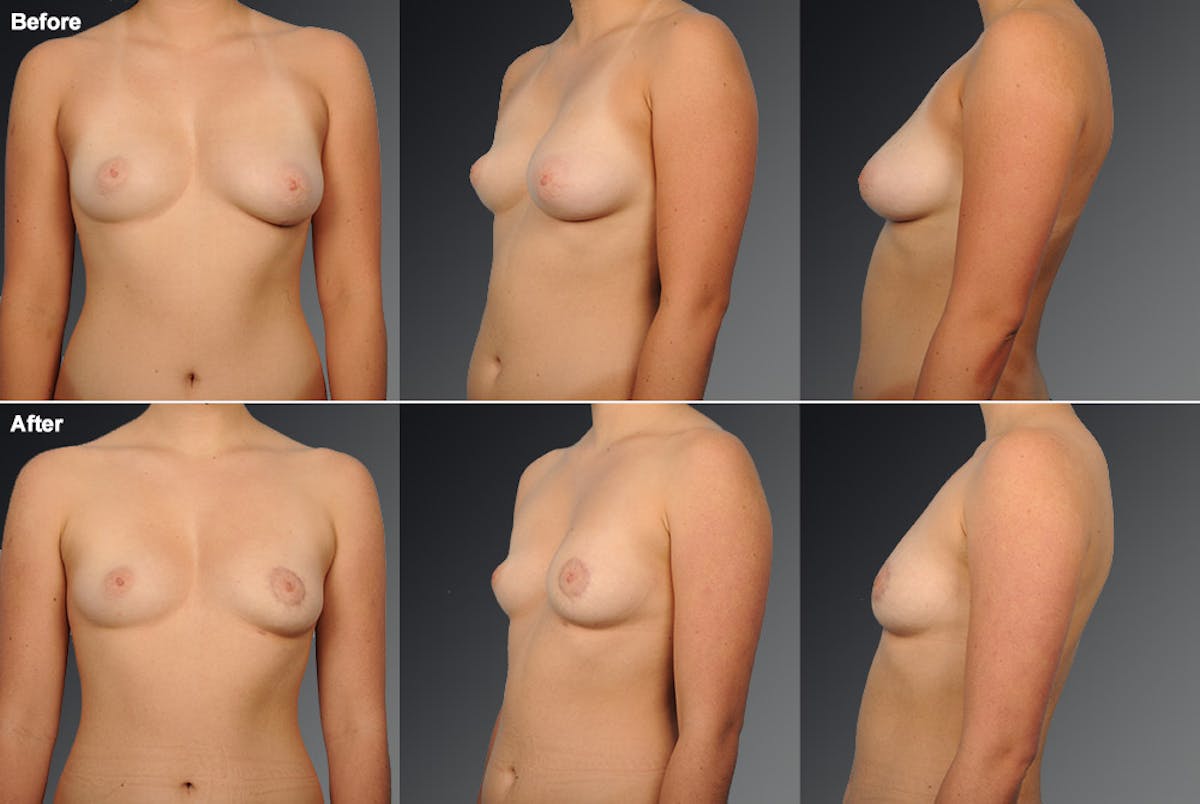 Breast Donut Lift Before & After Gallery - Patient 105454267 - Image 1