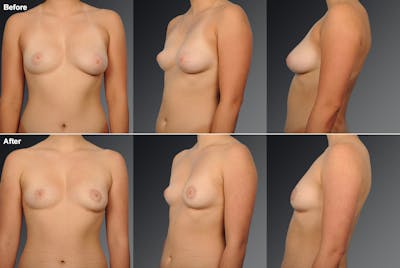 Breast Donut Lift Before & After Gallery - Patient 105454267 - Image 1