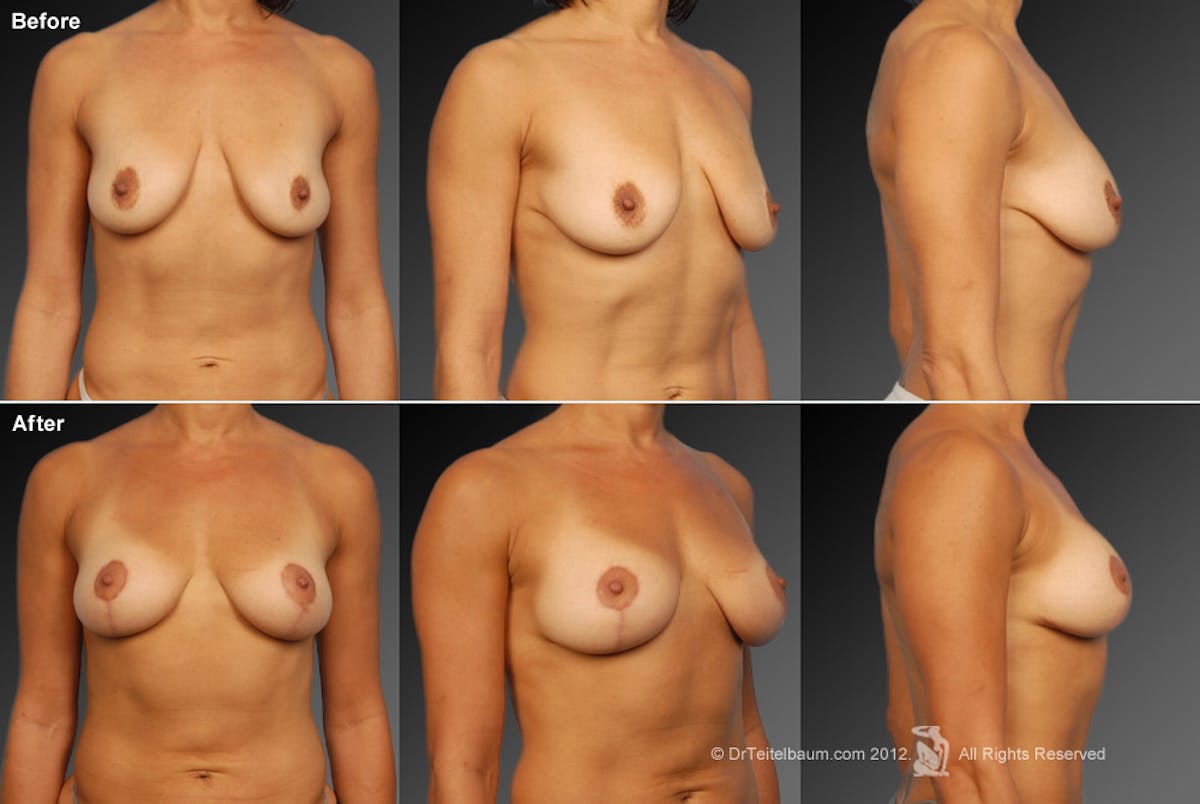 Breast Anchor Lift Before & After Gallery - Patient 105454396 - Image 1