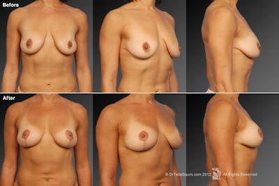 Breast Anchor Lift Before & After Gallery - Patient 105454396 - Image 1