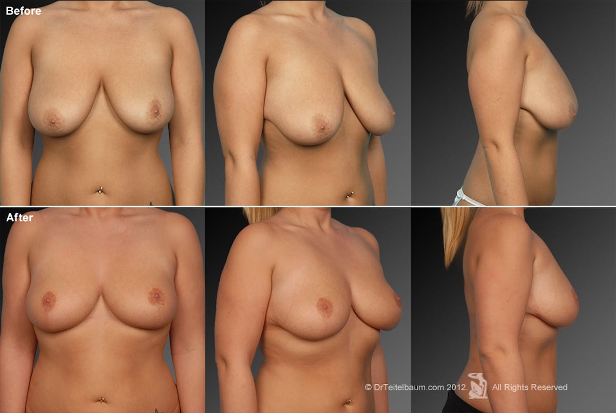 Breast Anchor Lift Before & After Gallery - Patient 105454468 - Image 1