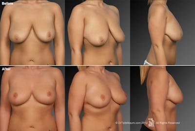 Breast Anchor Lift Before & After Gallery - Patient 105454468 - Image 1
