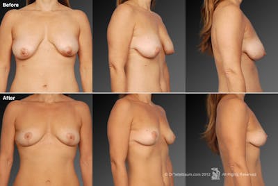 Breast Anchor Lift Before & After Gallery - Patient 105454489 - Image 1