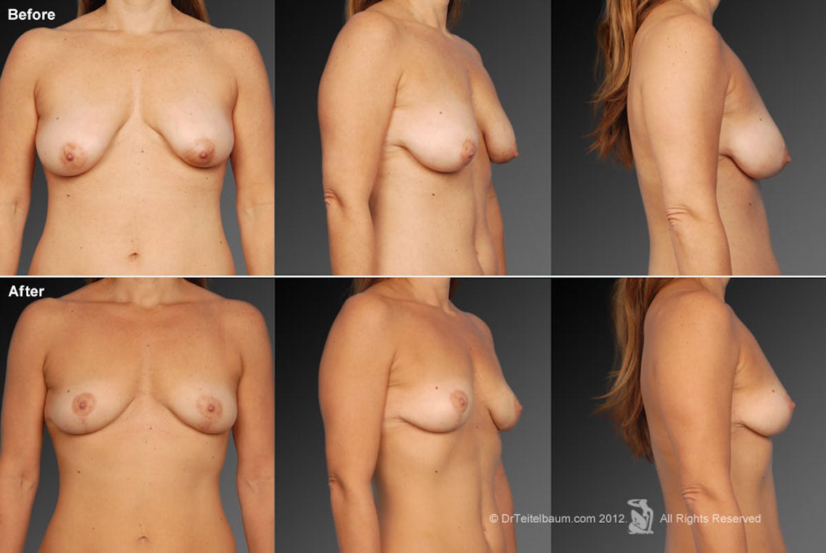 Breast Anchor Lift Before & After Gallery - Patient 105454489 - Image 1