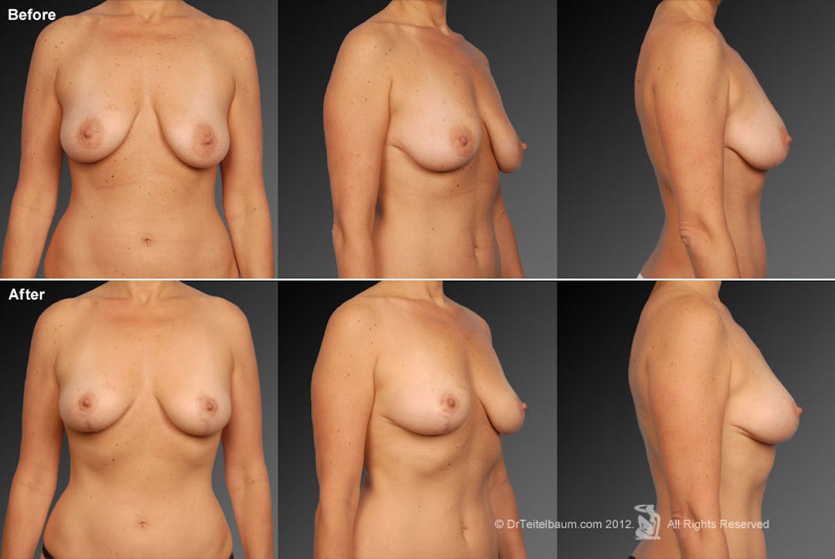 Breast Anchor Lift Before & After Gallery - Patient 105454490 - Image 1