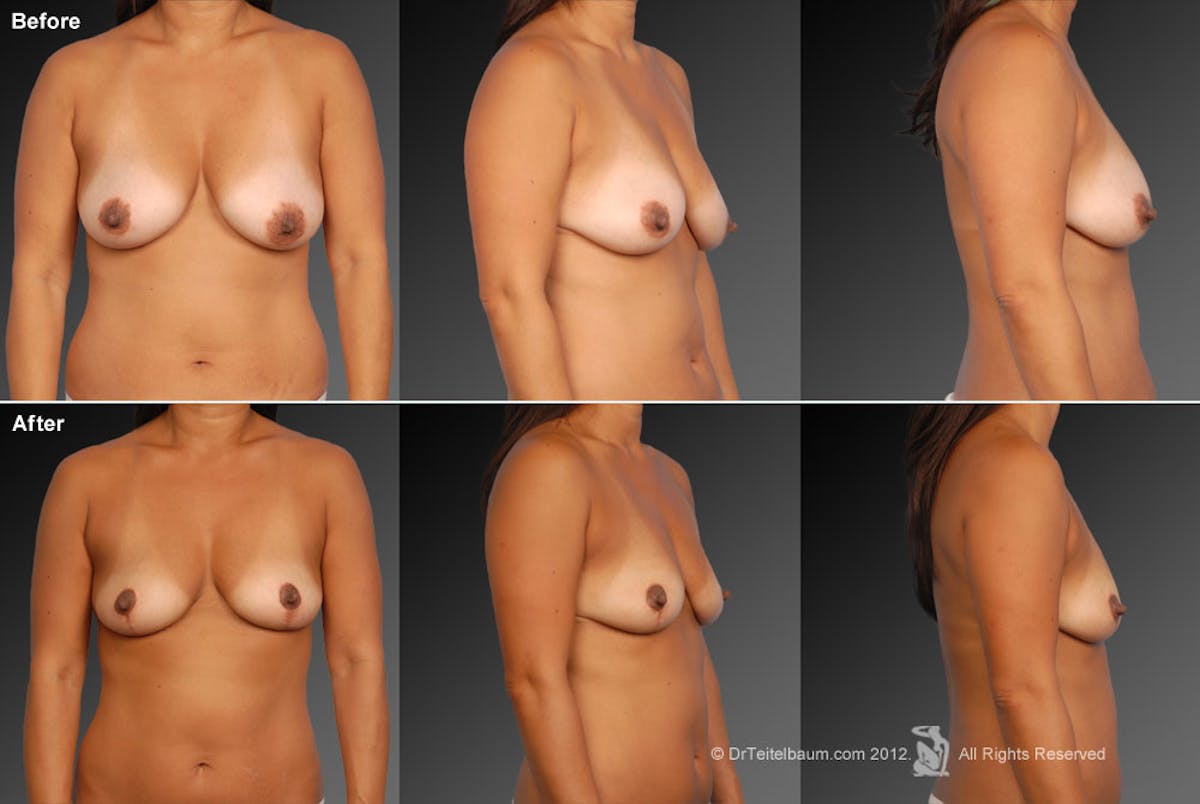 Breast Anchor Lift Before & After Gallery - Patient 105454496 - Image 1