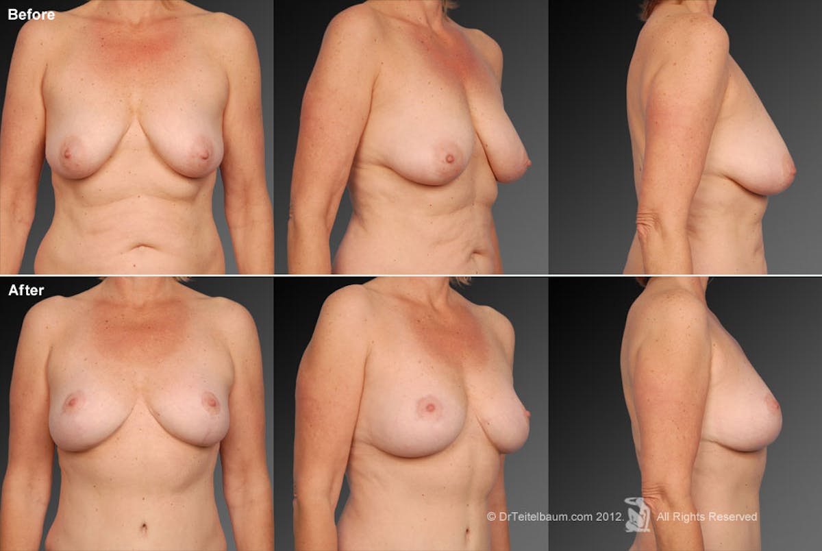 Breast Anchor Lift Before & After Gallery - Patient 105454500 - Image 1