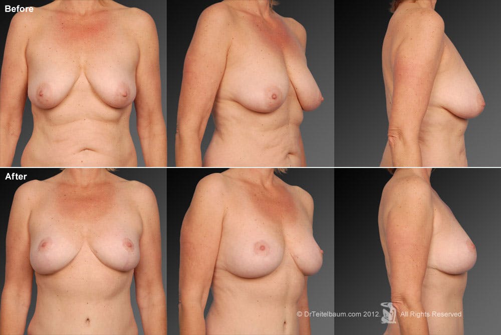 Breast Anchor Lift Before & After Gallery - Patient 105454500 - Image 1