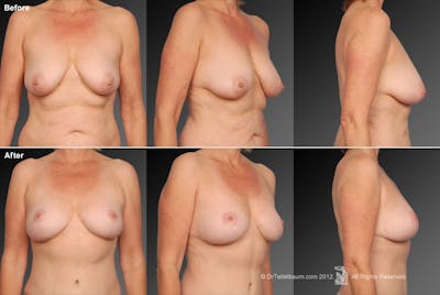 Breast Anchor Lift Before & After Gallery - Patient 105454500 - Image 1