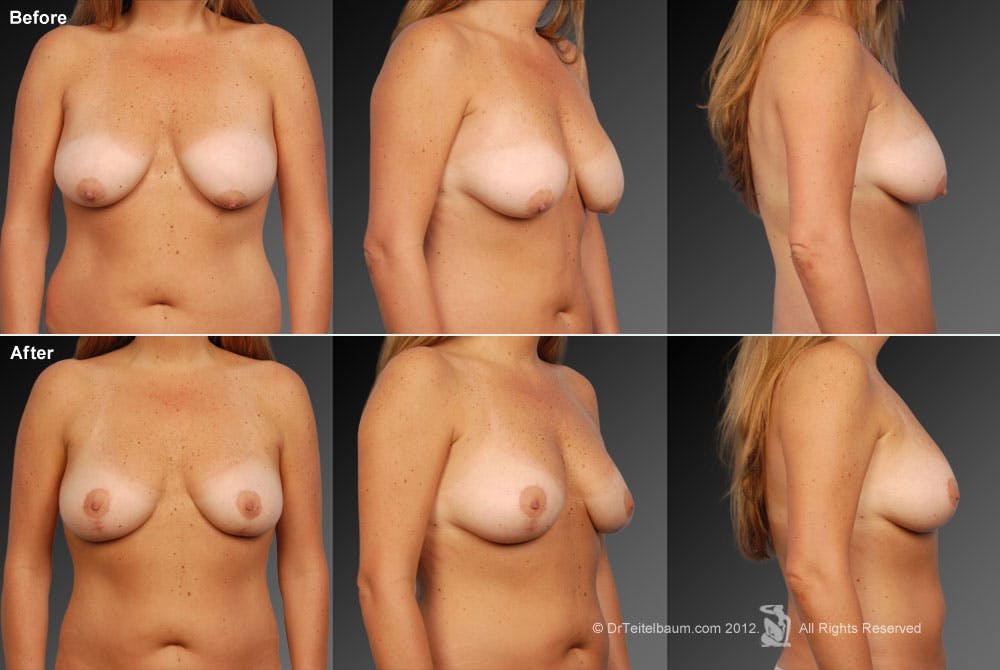 Breast Anchor Lift Before & After Gallery - Patient 105454504 - Image 1