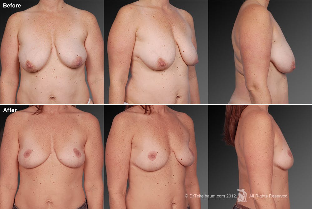 Breast Anchor Lift Before & After Gallery - Patient 105463997 - Image 1