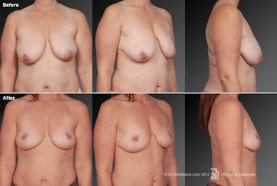 Breast Anchor Lift Before & After Gallery - Patient 105463997 - Image 1