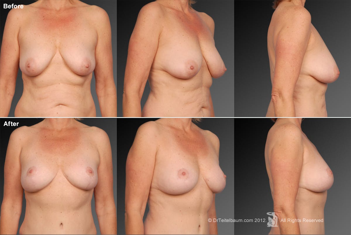 Breast Anchor Lift Before & After Gallery - Patient 105464009 - Image 1