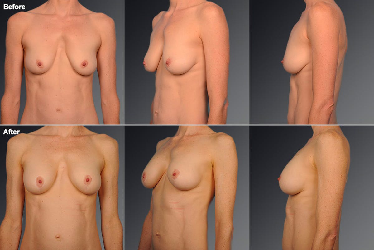 Breast Anchor Lift Before & After Gallery - Patient 105464011 - Image 1