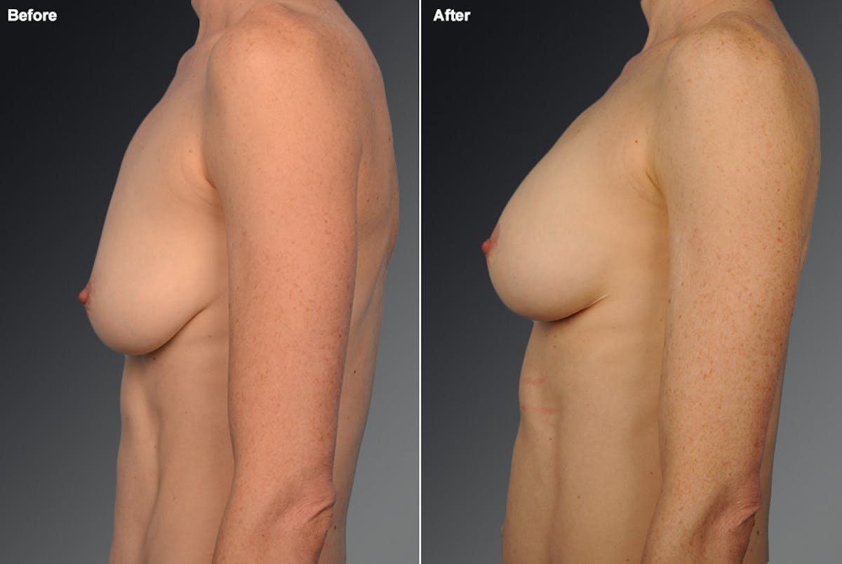 Breast Anchor Lift Before & After Gallery - Patient 105464013 - Image 1