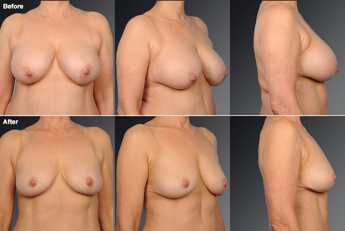 Breast Anchor Lift Before & After Gallery - Patient 105464023 - Image 1