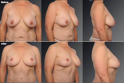 Breast Anchor Lift Before & After Gallery - Patient 105464025 - Image 1