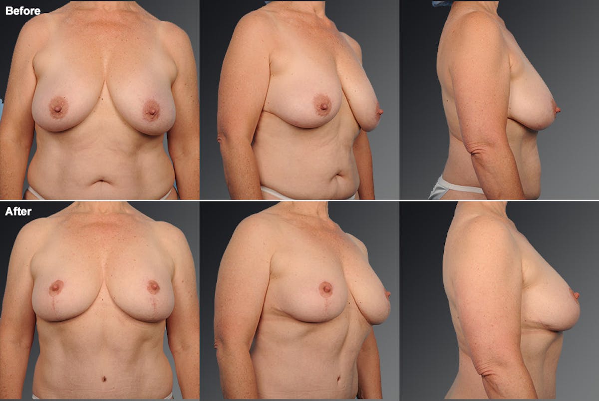 Breast Anchor Lift Before & After Gallery - Patient 105464025 - Image 1