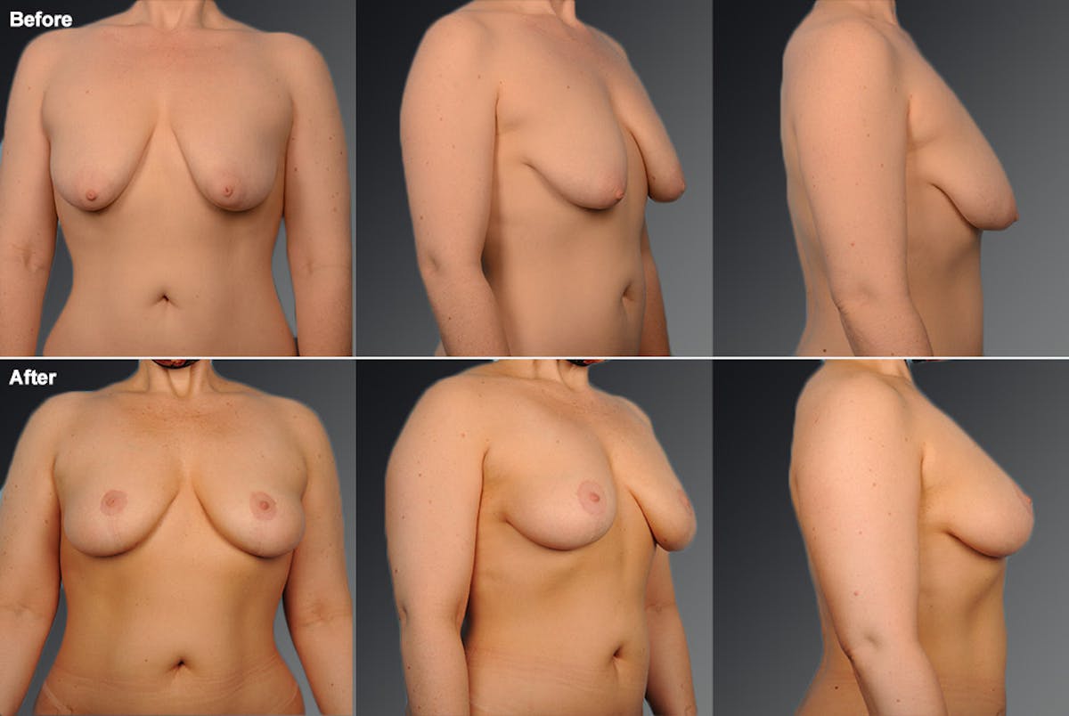 Breast Anchor Lift Before & After Gallery - Patient 105464031 - Image 1