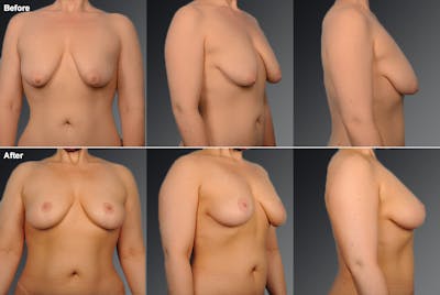 Breast Anchor Lift Before & After Gallery - Patient 105464031 - Image 1