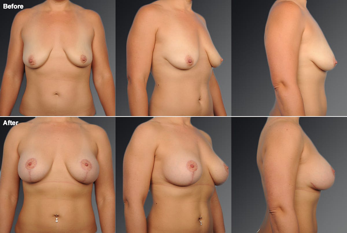 Breast Anchor Lift Before & After Gallery - Patient 105464036 - Image 1