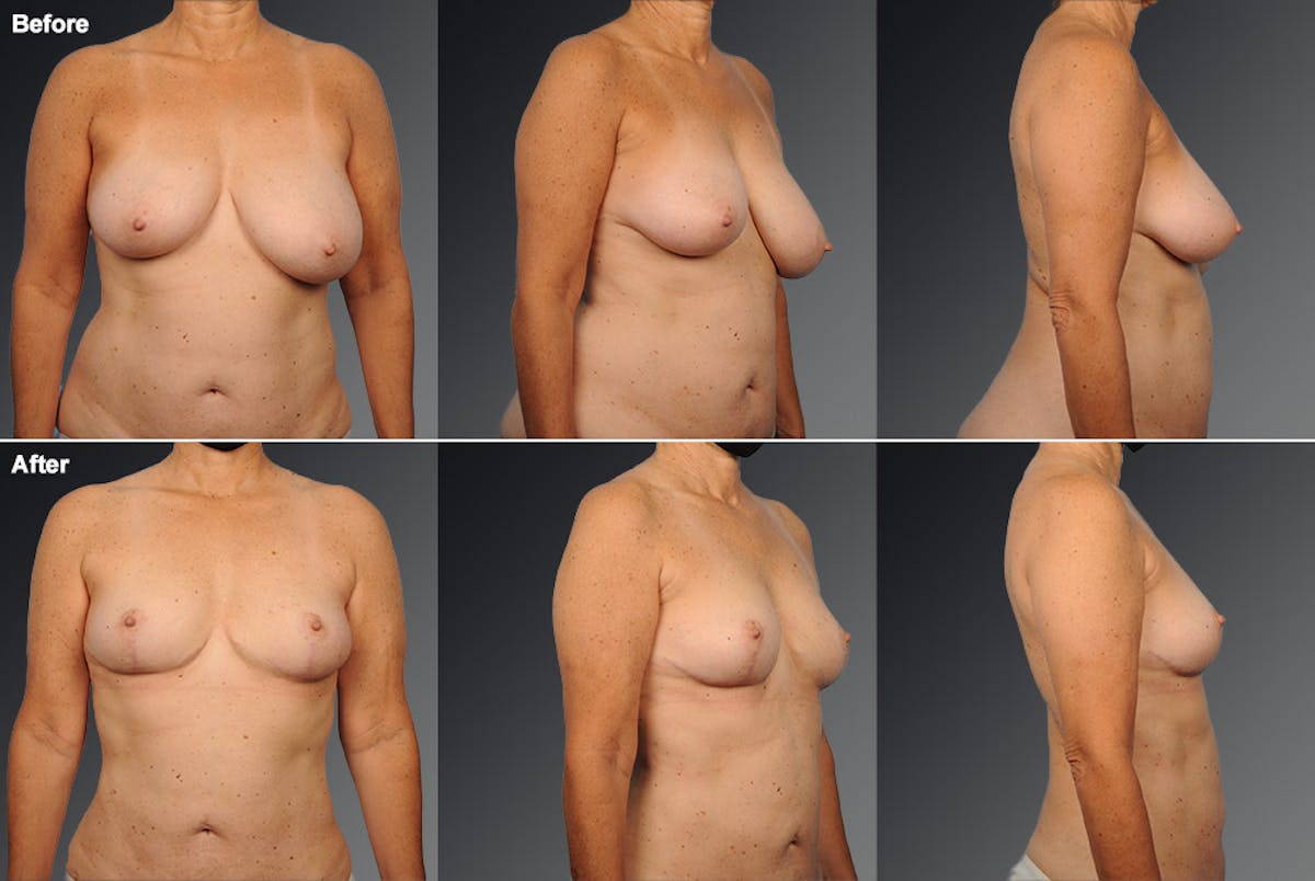 Breast Anchor Lift Before & After Gallery - Patient 105464038 - Image 1
