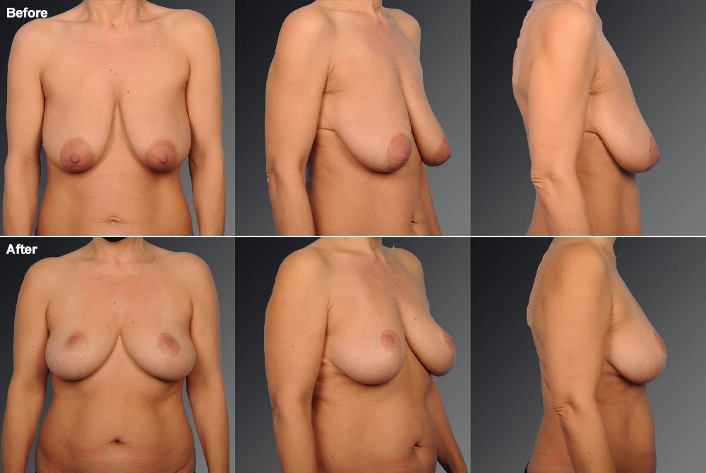Breast Anchor Lift Before & After Gallery - Patient 105464041 - Image 1