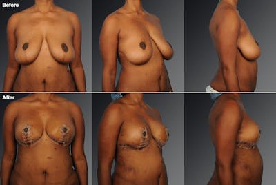 Breast Anchor Lift Before & After Gallery - Patient 105464043 - Image 1
