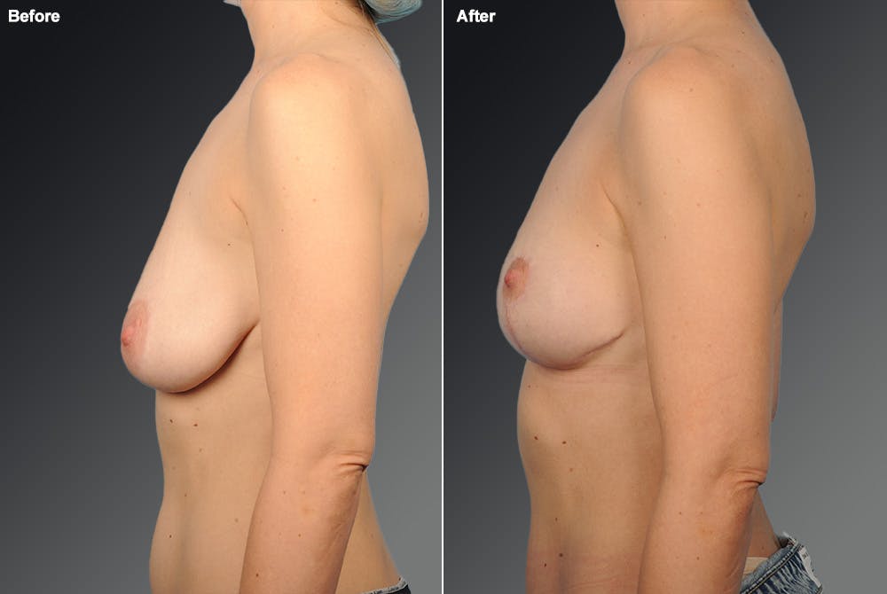 Breast Anchor Lift Before & After Gallery - Patient 105464056 - Image 1