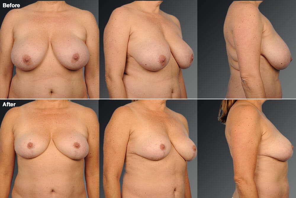 Breast Reduction Before & After Gallery - Patient 105470017 - Image 1