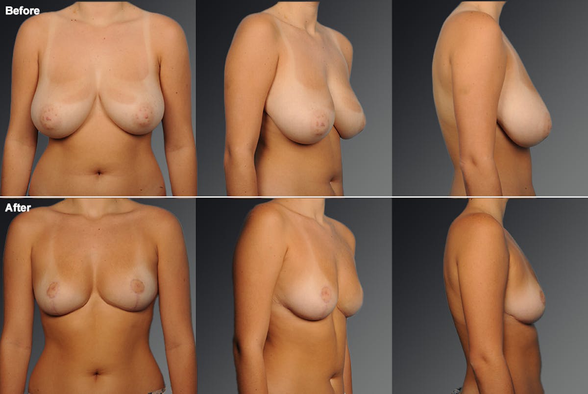 Breast Reduction Before & After Gallery - Patient 105470021 - Image 1