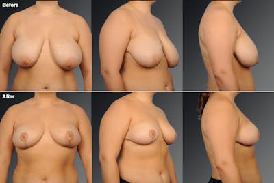 Breast Reduction Before & After Gallery - Patient 105470023 - Image 1