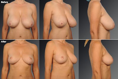 Breast Reduction Before & After Gallery - Patient 105470024 - Image 1