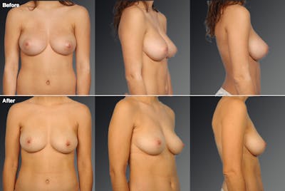 Breast Reduction Before & After Gallery - Patient 105470025 - Image 1