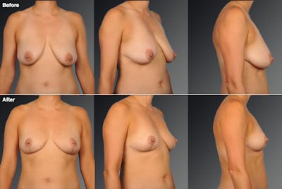 Breast Reduction Before & After Gallery - Patient 105470026 - Image 1