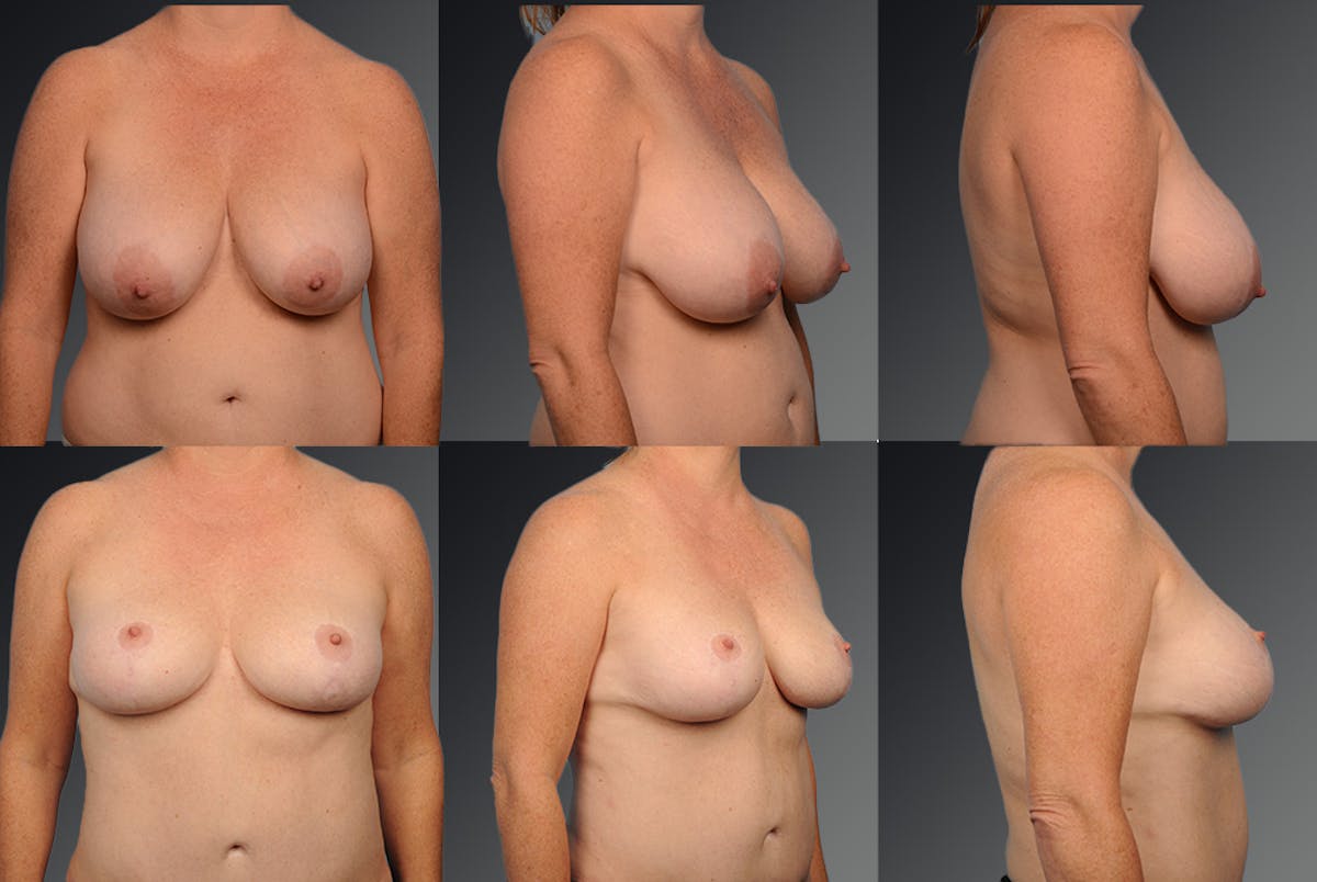 Breast Reduction Before & After Gallery - Patient 105470042 - Image 1