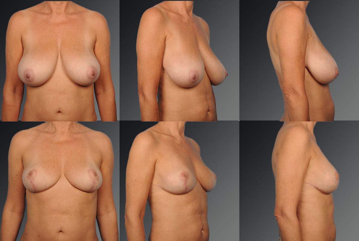 Breast Reduction Before & After Gallery - Patient 105470043 - Image 1