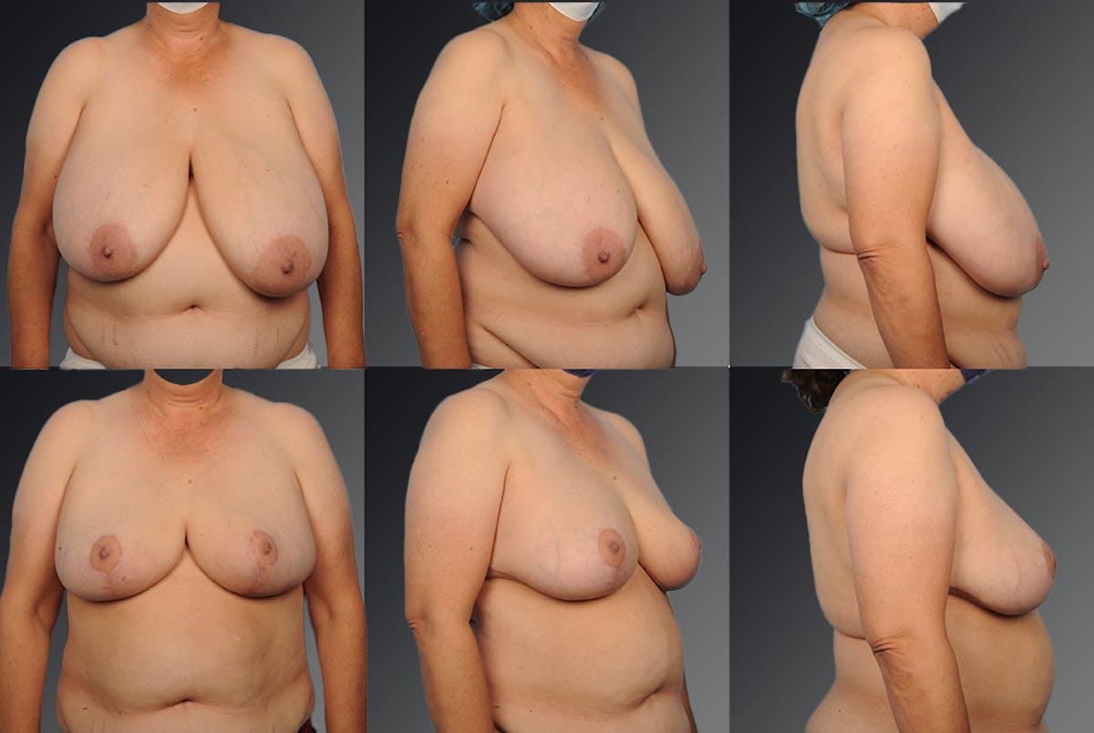 Breast Reduction Before & After Gallery - Patient 105470047 - Image 1