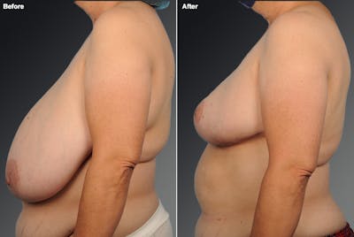 Breast Reduction Before & After Gallery - Patient 105470049 - Image 1