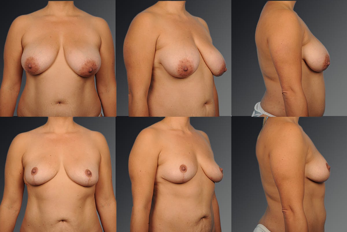 Breast Reduction Before & After Gallery - Patient 105470050 - Image 1