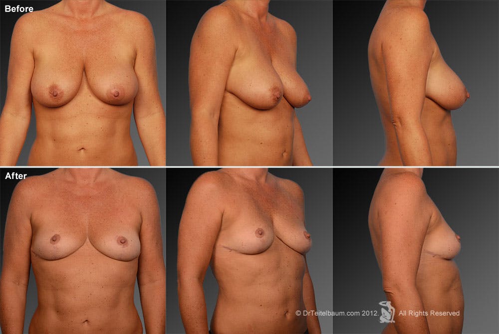 Breast Reduction Before & After Gallery - Patient 105470054 - Image 1