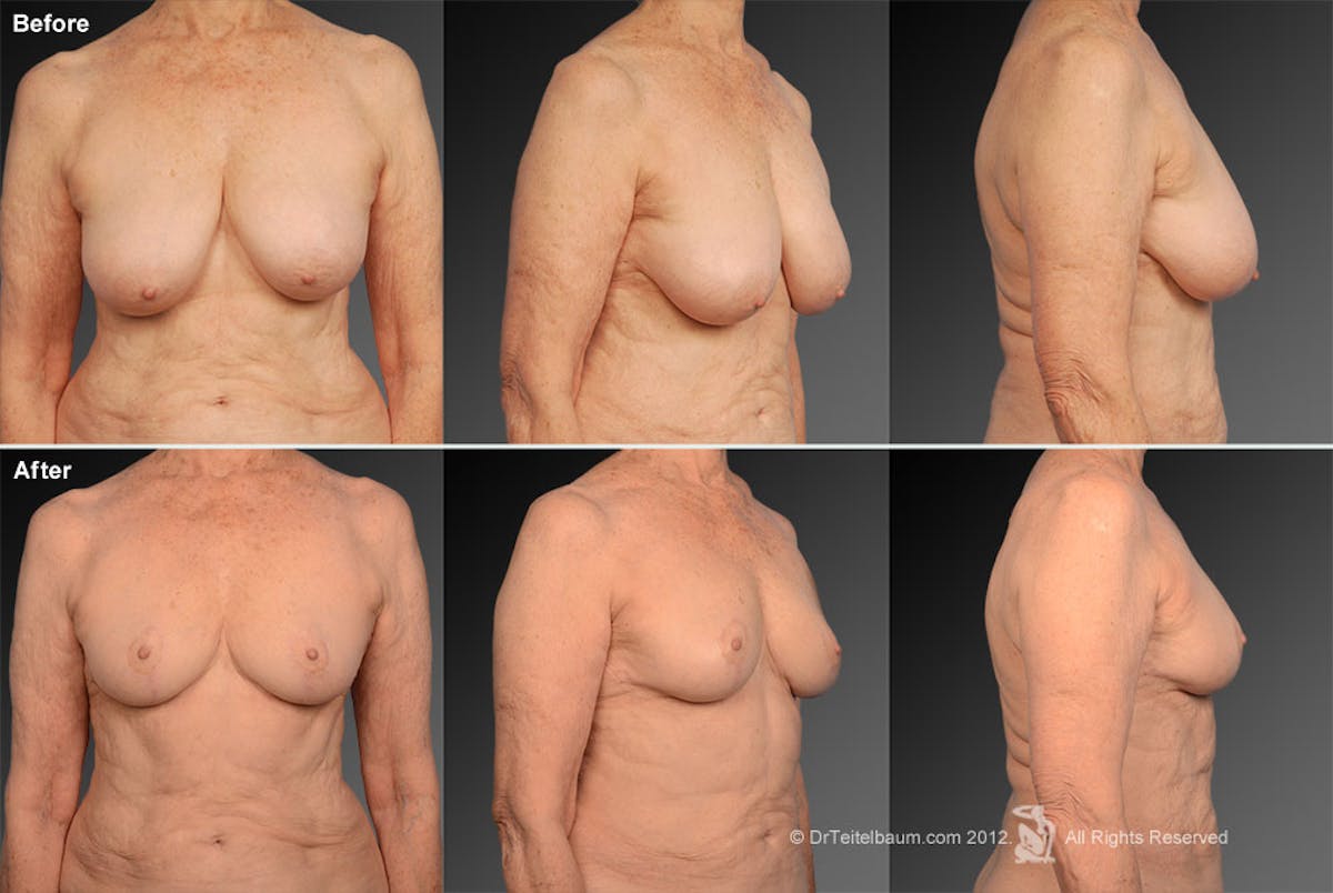 Breast Reduction Before & After Gallery - Patient 105470055 - Image 1